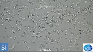 Pus cells in urine Pyuria1 [upl. by Rolo726]