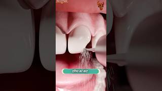 How teeth are fixed 😳 दांत कैसे ठीक होते हैं  shorts [upl. by Paza587]