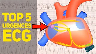 🔴 Le TOP 5 des Urgences à lEcg EXPLIQUÉES CLAIREMENT  ​ [upl. by Booker]