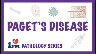 Pagets Disease  Pathology Causes Symptoms Diagnosis Treatment [upl. by Hales]