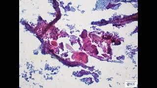 Thyroid cytology  Classical papillary thyroid carcinoma [upl. by Ahcurb499]