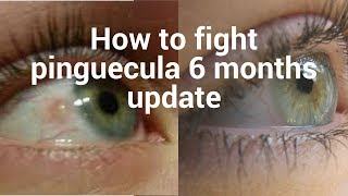 How to fight pinguecula update for 6 months [upl. by Allertse207]