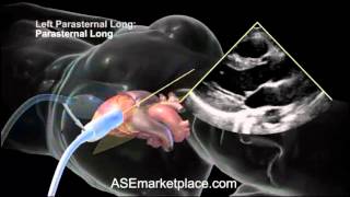 How to do a Basic Transthoracic Echocardiogram Transducer Position and Anatomy [upl. by Katherina]