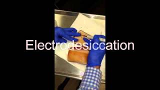 Electrodesiccation and Curettage EDampC  How To [upl. by Selim]