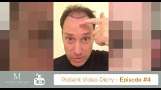 FUT Hair Transplant Review – The Day Before Surgery – Video Diary 4 [upl. by Oretna404]