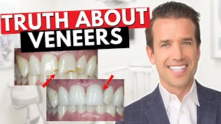 Before you get Dental Veneers Watch This  Are Veneers Worth It [upl. by Sadiras]