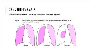 le Drainage Thoracique chez un patient à Hôpital [upl. by Sheffie]