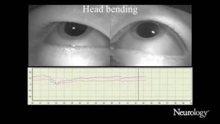 Xlinked adrenoleukodystrophy presenting with positional downbeat nystagmus [upl. by Piks]