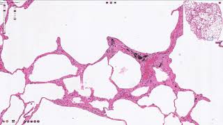 Emphysema  Histopathology [upl. by Eelarac440]