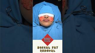 Permanent Mid Face Slimming With Buccal Fat Removal  Sarayu Clinics beauty [upl. by Noslien]