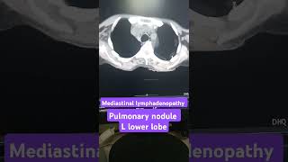 Mediastinal lymphadenopathy on CT scan pulmonary nodule on CT scan [upl. by Ressan]