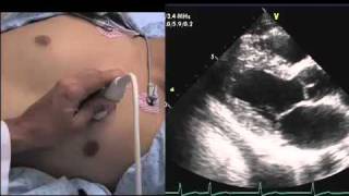 Echocardiography How to Find a Windowmov [upl. by Ruiz127]