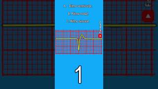 Electrocardiograma interpretación  ¿Qué ritmo sugiere el siguiente trazo de electrocardiograma [upl. by Eenal]