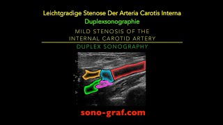 Duplexsonographie  Leichtgradige Stenose Der Arteria Carotis Interna [upl. by Htebilil]