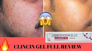 CLINCIN GEL FULL REVIEW IN DETAILक्या कील मुहासे होंगे गायब😃😰🤨🤨 [upl. by Nishom]