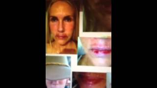 Carac Flourouracil Topical Chemotherapy Treatment on Lips [upl. by Benia]