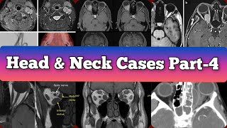 Radiology Viva Cases  393398  Head and Neck Exam Cases Part 4 medical radiology [upl. by Broadbent]