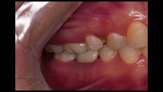 Orthodontic intrusion of upper molars  pre  Scan  Deliver the crowns❤️ [upl. by Peterson]