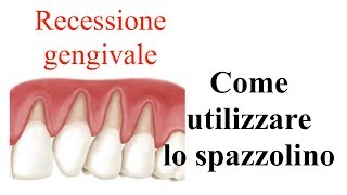 Come utilizzare lo spazzolino in caso di recessione gengivale [upl. by Patricia]