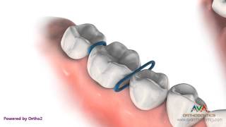 Orthodontic Separator or Spacer  Rubber ORings [upl. by Ayatnwahs]