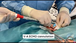 ECMO cannulation [upl. by Woo]