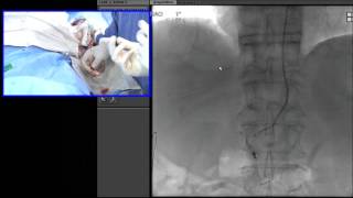 Transradial Embolization of the Right Gastric Artery Prior to Y90 Radioembolization [upl. by Folger]