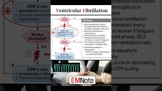 Ventricular Fibrillation VFib [upl. by Eerised936]