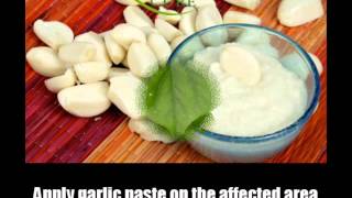 5 Scabies Home Remedies Natural Treatments And Cures [upl. by Notlim739]