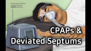 CPAPs and Septal Deviations [upl. by Micah]