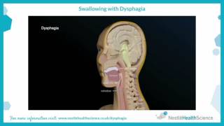 Swallowing with Dysphagia [upl. by Nylyahs382]