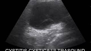 CASE 472 CYSTITIS CYSTICA [upl. by Alwin]