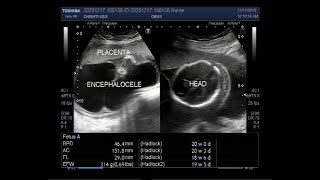 Two large Encephaloceles Hydrops fetalis pericardial effusion ascites and soft tissue edema [upl. by Nah]