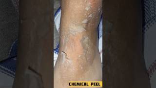 Chemical Peel At Home  Pigmentation  Melasma Acne Scars Tanning peeling chemicalpeel short [upl. by Koerlin61]