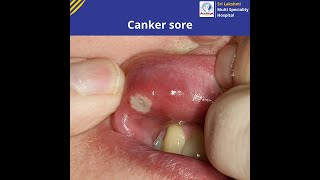 Canker sore   Know Symptoms and Causes of Canker sore   slmsh [upl. by Newmark360]