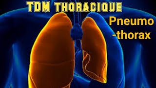 SCANNER THORACIQUE Pneumothorax avec collapsus passif [upl. by Ameen]