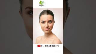 acnestar gel uses  pimpal amp acne removals cream  पिंपल के लिए क्रीम [upl. by Dusen]