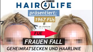 Haartransplantation Frauen  Geheimratsecken amp Haarlinie  Vorher Nachher  Dr Bijan Feriduni [upl. by Rosenberg]