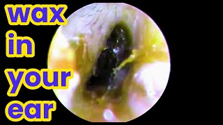 wax in your ear  Ear health  ear piercing cleaning how to unclog your ear  Removing cerumen [upl. by Esina]