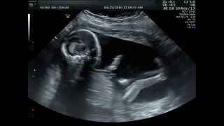 20 week Ultrasound Its a boy [upl. by Ranson10]