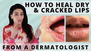 How to Heal Dry amp Cracked Lips Fast  Dermatologist Reveals [upl. by Annahavas]