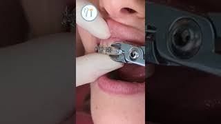 Braces Removal after orthodontic treatment braces bracesoff bracesadjustment [upl. by Adnesor901]