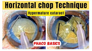 Phaco basics Horizontal chop Technique in free floating nucleus amp Hypermature cataract [upl. by Ettenawtna471]