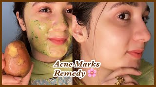 7 days Challenge  Remove Acne scars  Marks  soft and healthy Skin [upl. by Uzial]