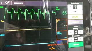 QRS Asystolic Beats [upl. by Oirram]