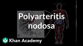 Polyarteritis nodosa  Circulatory System and Disease  NCLEXRN  Khan Academy [upl. by Seve]