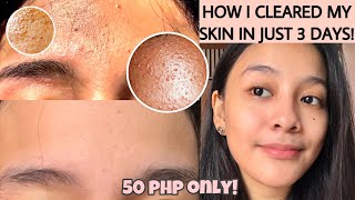 HOW TO GET RID OF TINY BUMPS ON FOREHEADFACE FAST  FUNGAL ACNE how i cleared my skin ENG SUB [upl. by Enoid]