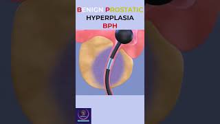 Benign Prostatic Hyperplasia education shorts [upl. by Fidelio]