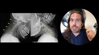 Cervical Instability Dizziness amp Headaches Do I need injections Chiropractor Spokane [upl. by Milford853]