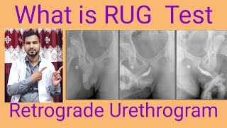 What is RUG Test  Retrograde Urethrogram complete study  by BL Kumawat [upl. by Elburt]