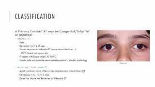 Constant Exotropia Characteristics [upl. by Giulio490]